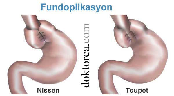 kısmi (Toupet) veya tam (Nissen) Fundoplikasyon