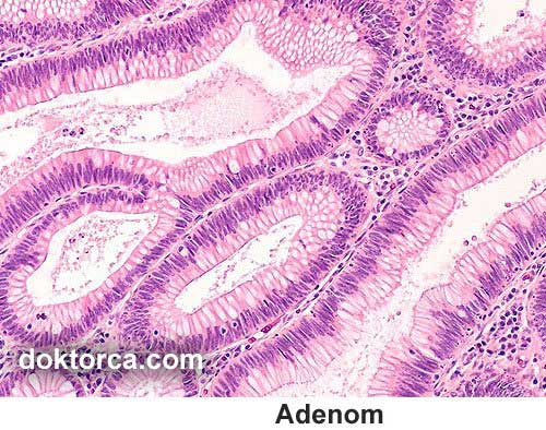 ADENOMA, beze veya gland anlamına geliyor ve salgı yapan iyi huylu hücrelerden köken alır.