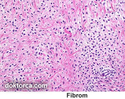 FİBROMA, bağ dokusunun fibroid hücrelerinden kaynaklanan iyi huylu ve temiz bir oluşumdur.