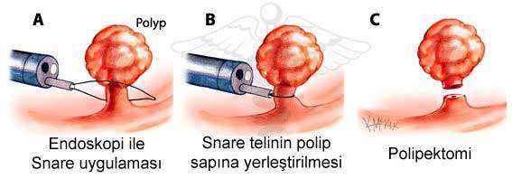 Polip tedavi nasıl yapılır?