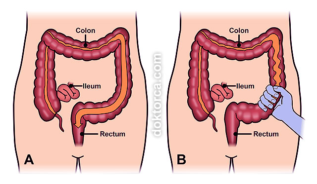 Recetas para colon irritable