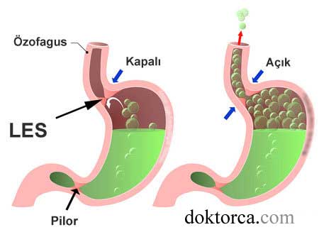 Les - Kös yetersizliği mekanizması