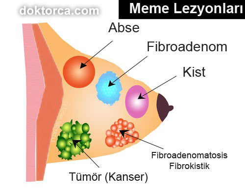 meme lezyonları fibroadenoma