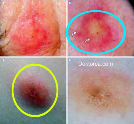 Amelanotik ve desmoplastik melanomlar