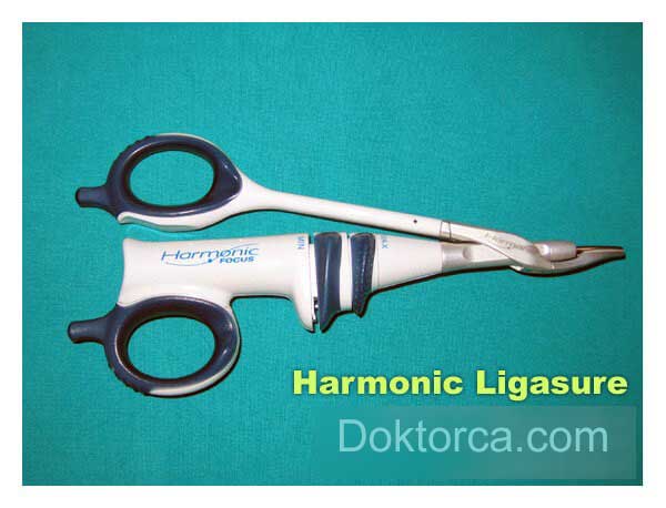 Harmonic ligasure