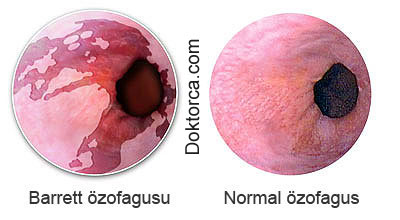 Gastroskopi esnasında görülen Barret özofagusu ve normal özofagus.