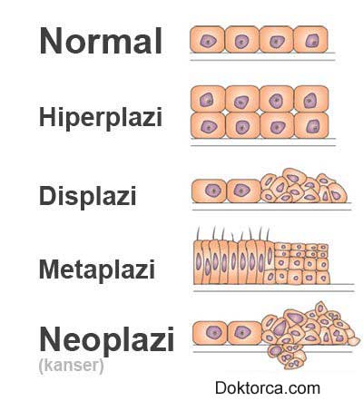 Displazi nedir?