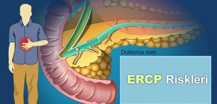 ERCP açılımı nedir?