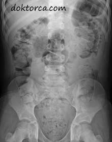 8 yaşındaki bir çocuğun düz röntgeninde belirgin kabızlık ADBG kabızlık nedir ve nasıl tedavi edilir? Kabızlık Nedir ve nasıl tedavi edilir? kabizlik filmi
