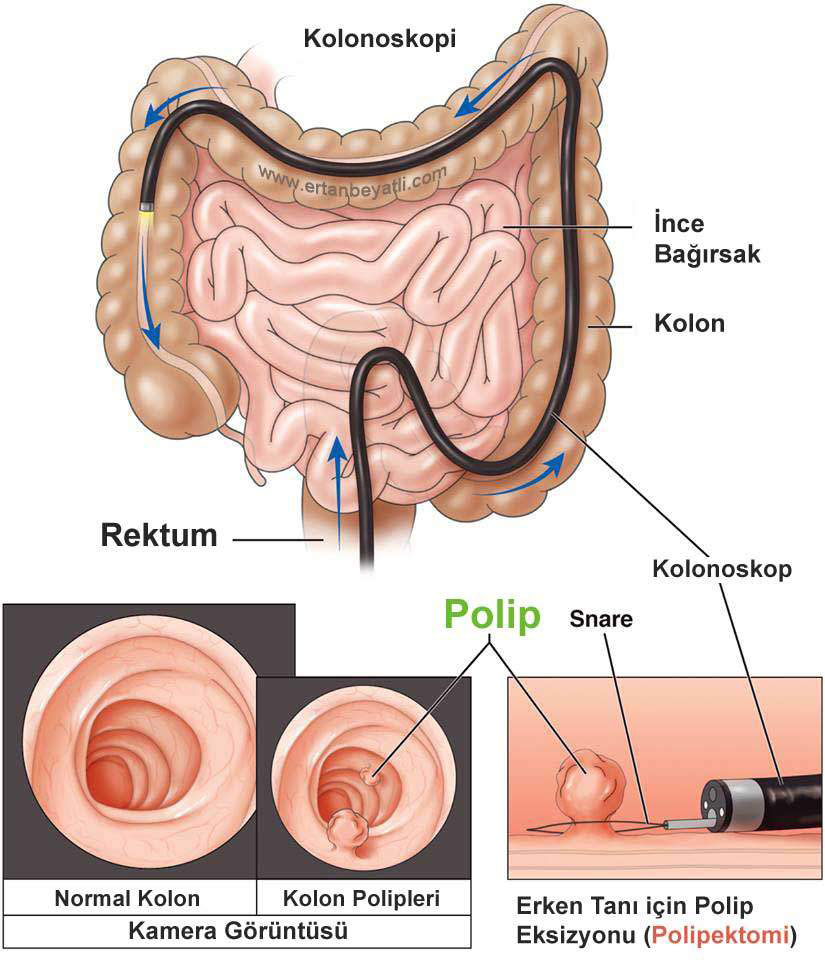 Kolonda et beni (Polip) kanser mi?