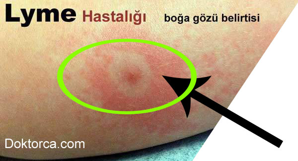 Lyme hastalığı nedir?