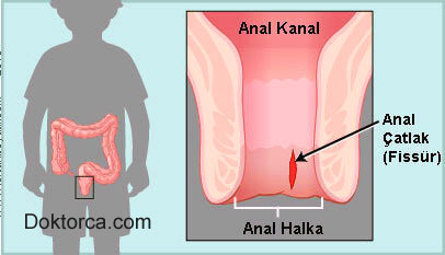 Anal Fissür için Kesin ve Kalıcı çözüm