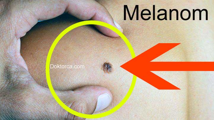 melanom nedir