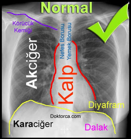 PA Akciğer Grafisi nedir ve ne zaman çekilir?