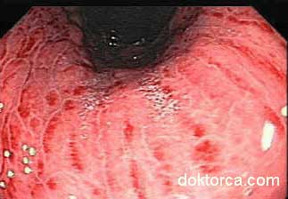Endoskopide görülen "Pangastrit" tablosu